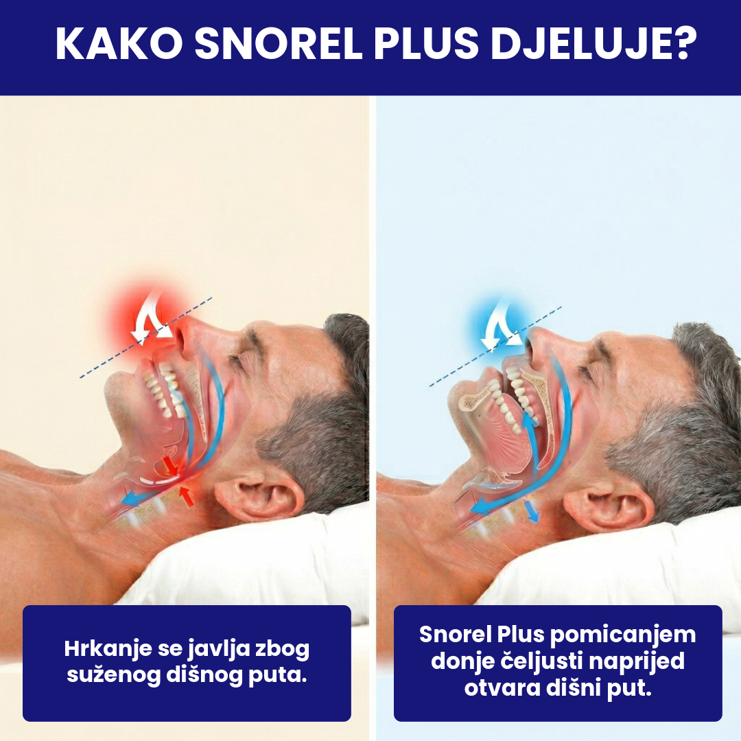 Snorel Plus™ - Aparat za pomoć kod hrkanja